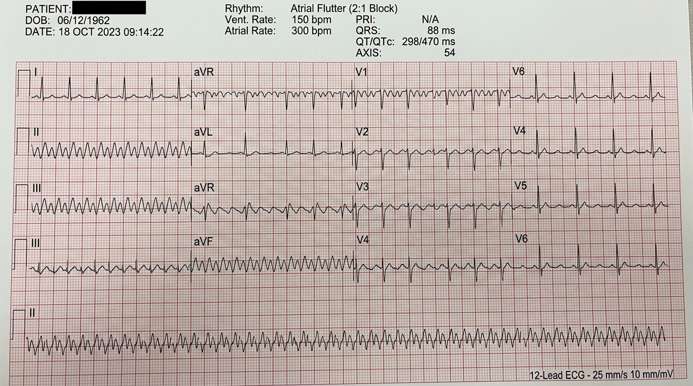 Atrial Flutter Sawtooth Strip