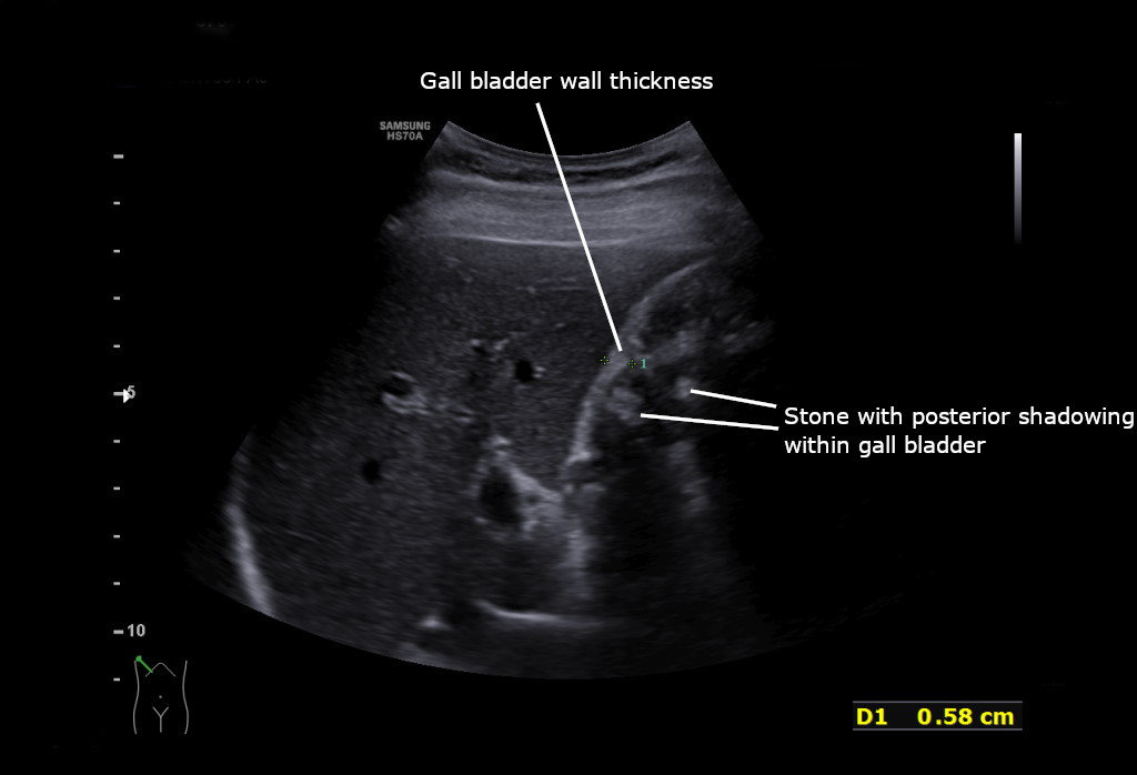Axial ultrasound of gallbladder showing acute cholecystitis with marked wall thickening and pericholecystic fluid halo