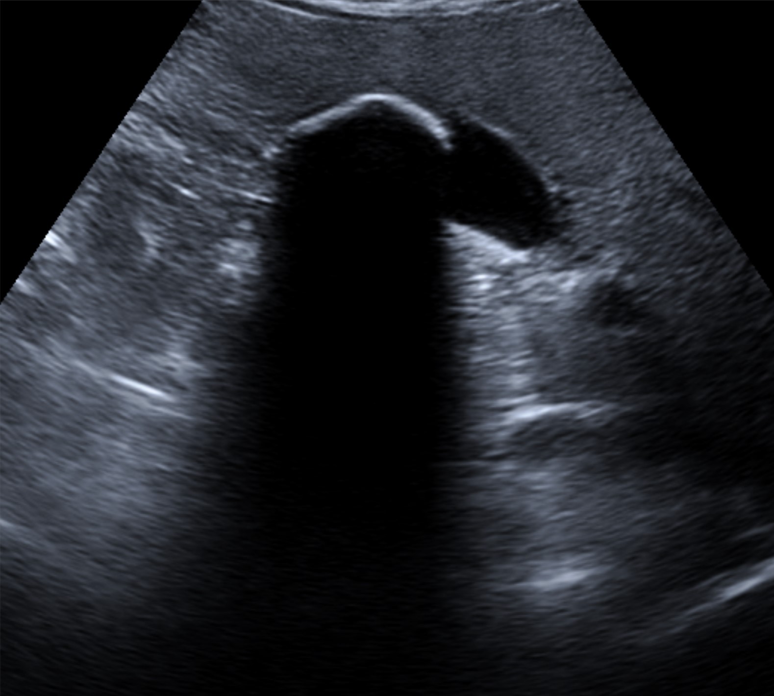 Right upper quadrant ultrasound demonstrating gallbladder with mobile hyperechoic calculus and clean posterior acoustic shadowing