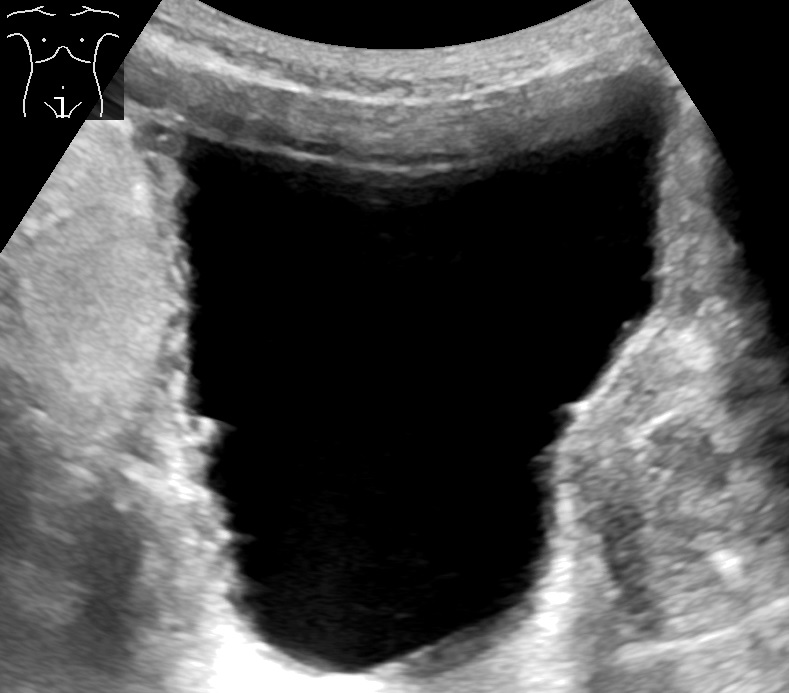 Pelvic ultrasound of urinary bladder showing severe detrusor wall thickening and prominent trabeculation from bladder outlet obstruction