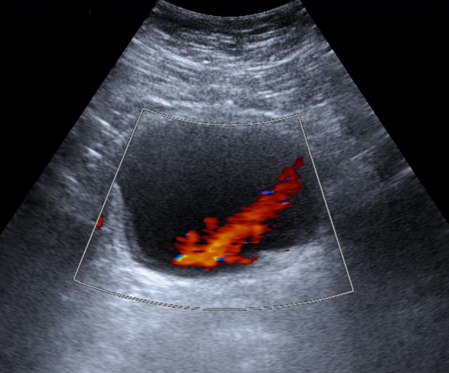 Transverse pelvic color Doppler ultrasound of urinary bladder showing right ureteral jet and absent left ureteral jet due to obstructing calculus
