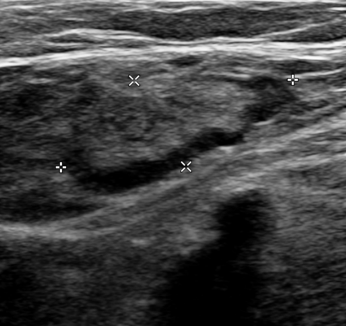 Common femoral vein compression ultrasound demonstrating non-compressible intraluminal deep vein thrombosis