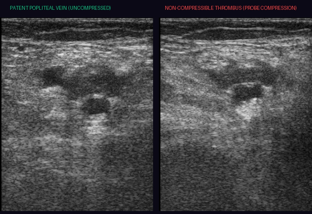 Popliteal fossa compression ultrasound comparison: uncompressed patent vein vs non-compressible popliteal thrombus