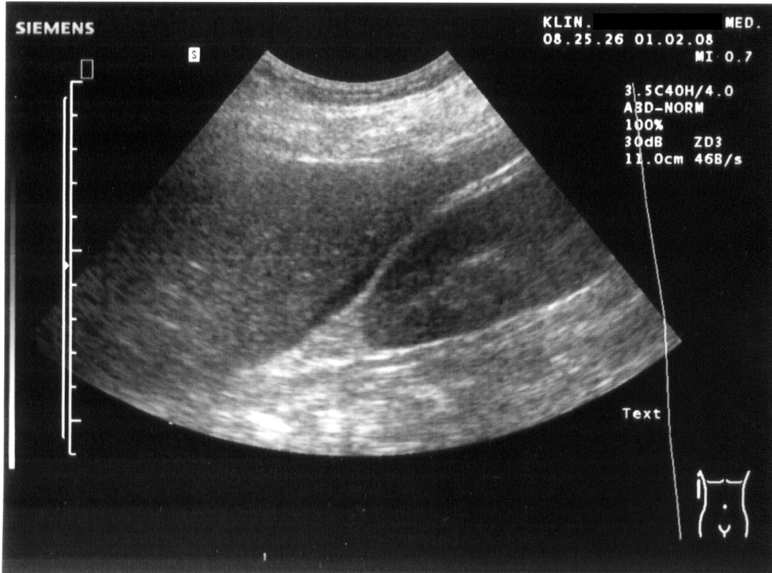 Right Upper Quadrant (RUQ) Morison Pouch ultrasound showing anechoic free fluid stripe in the hepatorenal space