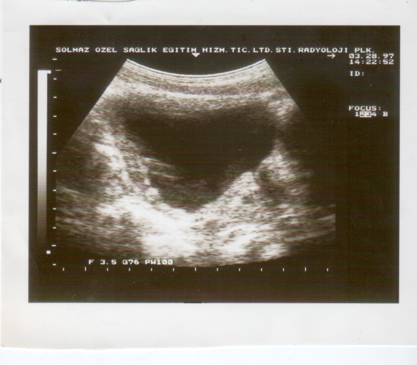 Suprapubic pelvic ultrasound view through urinary bladder demonstrating retrovesical acoustic window