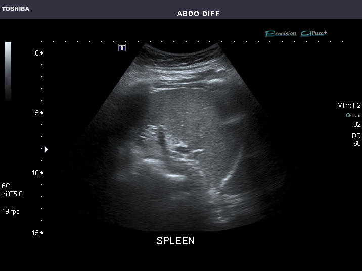 Left Upper Quadrant (LUQ) splenorenal ultrasound view showing spleen, left kidney, and subdiaphragmatic interface