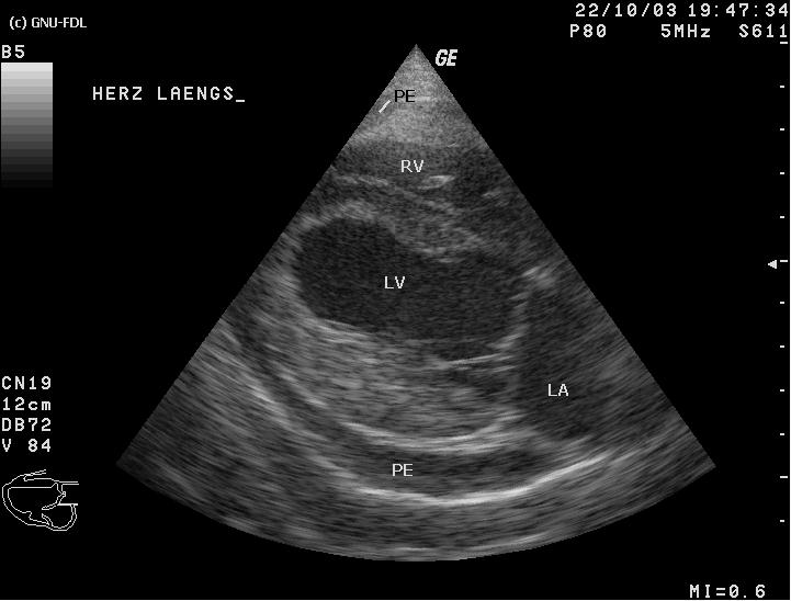 Subxiphoid pericardial ultrasound view demonstrating dark anechoic pericardial effusion surrounding the myocardium