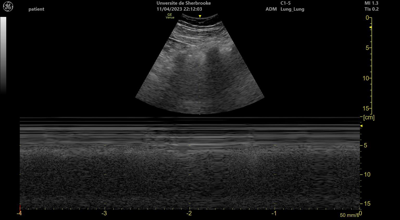 Thoracic lung ultrasound M-mode demonstrating the classic seashore sign of normal parietal and visceral pleural sliding