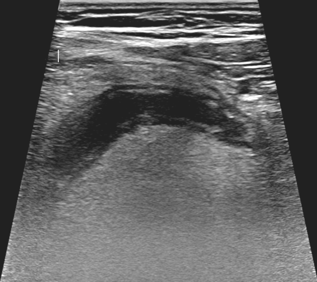 Transverse and longitudinal ultrasound of acute appendicitis demonstrating dilated non-compressible blind tube > 6 mm with target sign