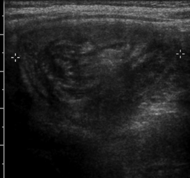 Transverse abdominal ultrasound revealing classic target or doughnut sign of pediatric ileocolic intussusception