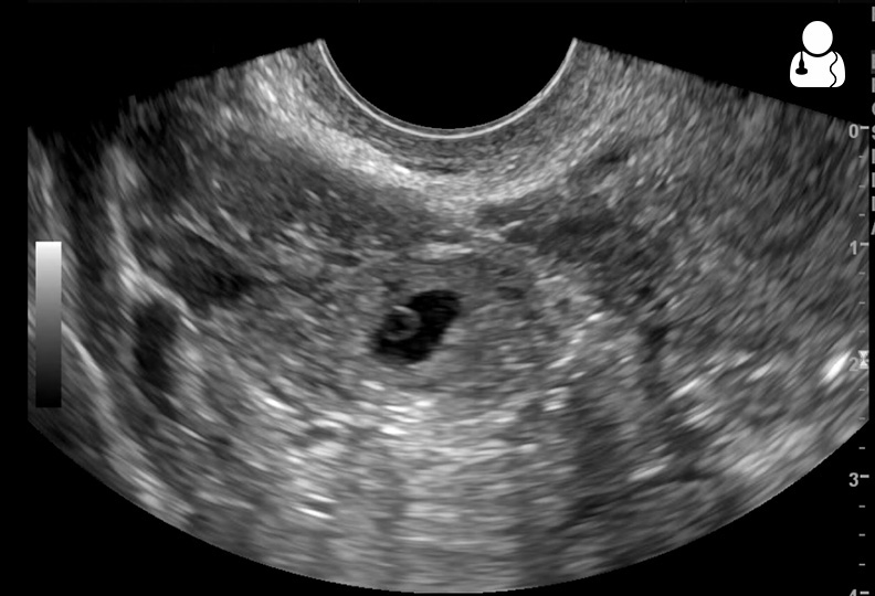 Pelvic ultrasound demonstrating tubal ectopic pregnancy presenting as an echogenic adnexal ring structure and surrounding free fluid
