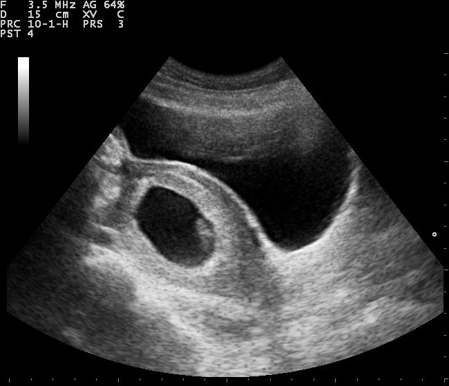 Transvaginal ultrasound of early intrauterine pregnancy showing gestational sac with prominent yolk sac and embryonic pole