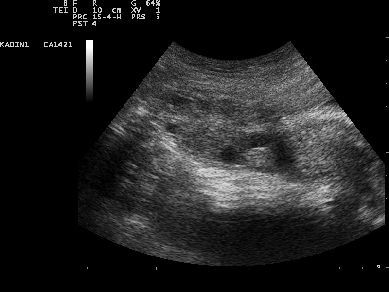 Pelvic ultrasound showing marked ovarian enlargement and stromal edema with peripheralized follicles in acute ovarian torsion