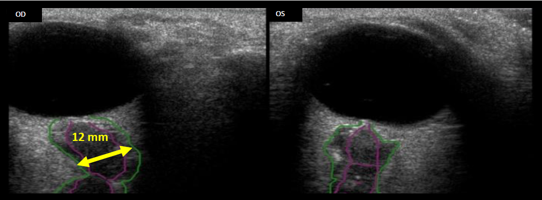 Optic nerve sheath diameter (ONSD) ultrasound showing dilated sheath measuring elevated intracranial pressure