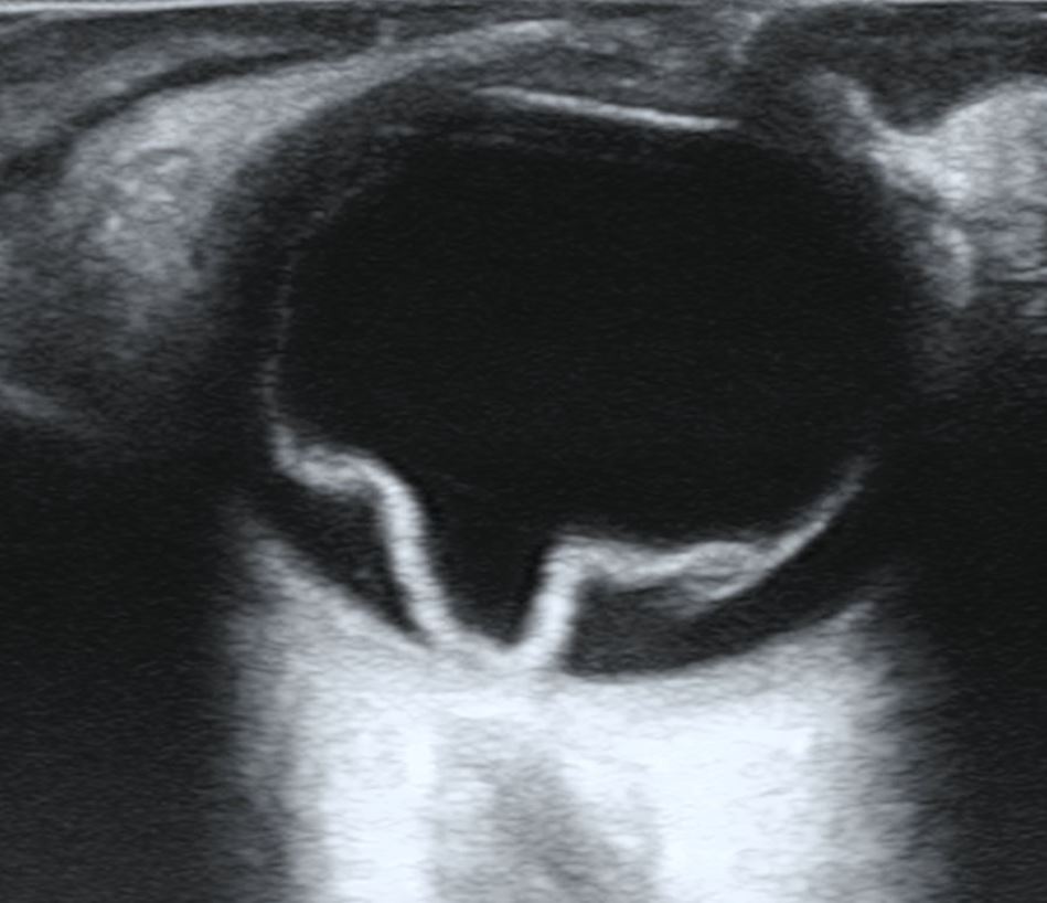 Bedside ocular ultrasound showing retinal detachment as a thick hyperechoic membrane anchored to the optic nerve head
