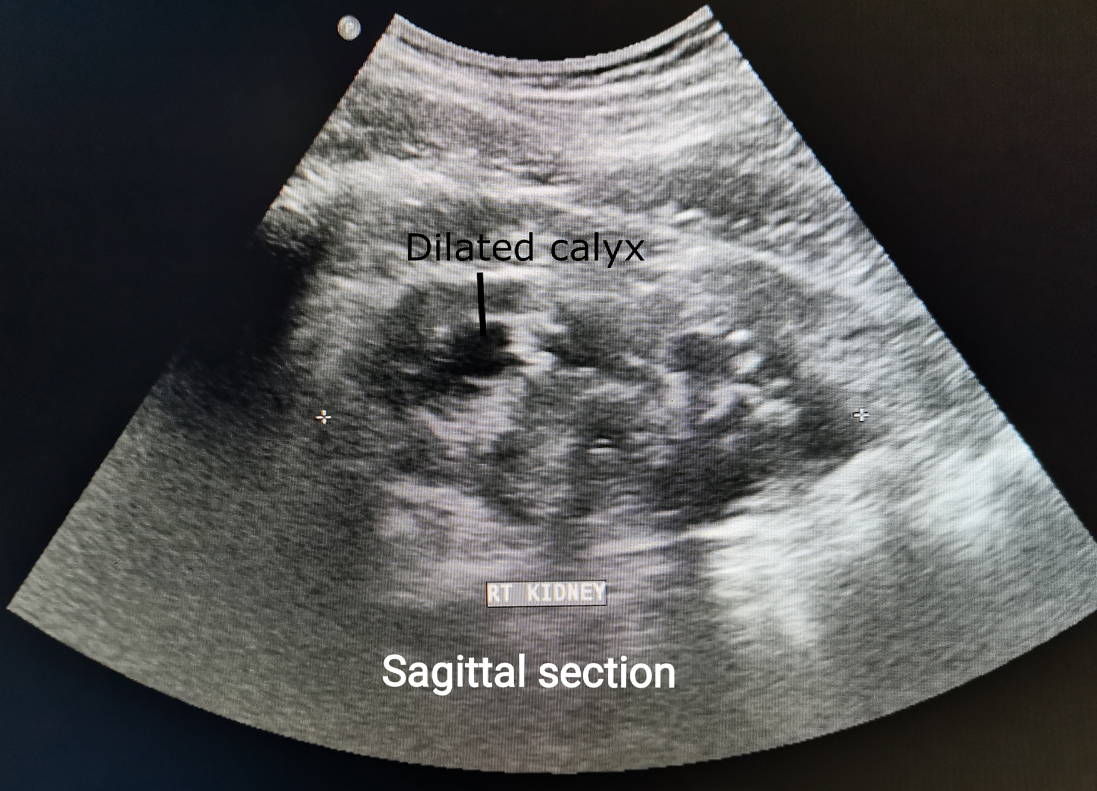 Renal ultrasound displaying moderate-to-severe hydronephrosis with branching anechoic dilatation of renal pelvis and major calyces