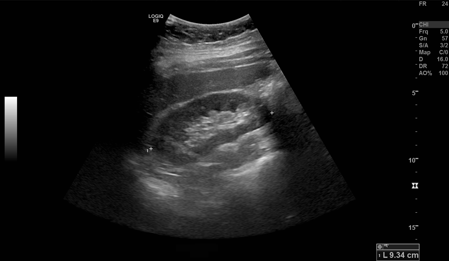 Normal longitudinal renal ultrasound displaying crisp corticomedullary differentiation, hypoechoic cortex, and bright central echogenic sinus