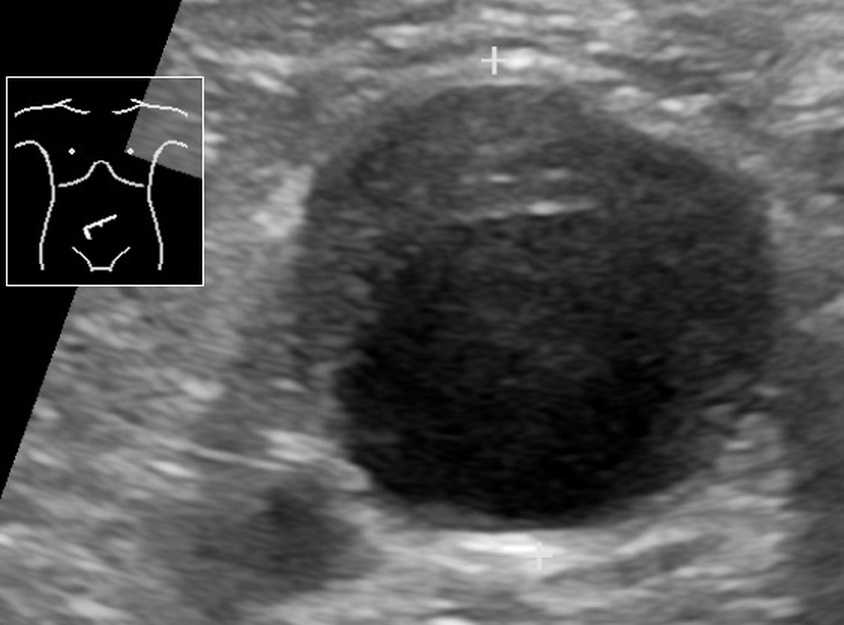 Abdominal aortic aneurysm (AAA) ultrasound in transverse axis showing marked dilation and crescentic mural thrombus