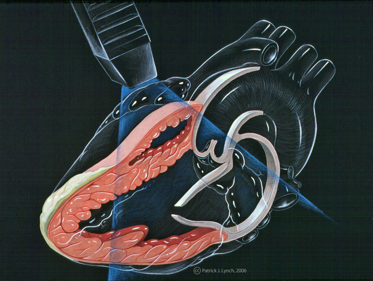 Parasternal Long Axis (PLAX) echocardiogram showing left ventricle, right ventricle outflow tract, aortic valve, and left atrium