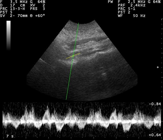 Inferior Vena Cava (IVC) longitudinal ultrasound and Doppler evaluation at the cavoatrial junction