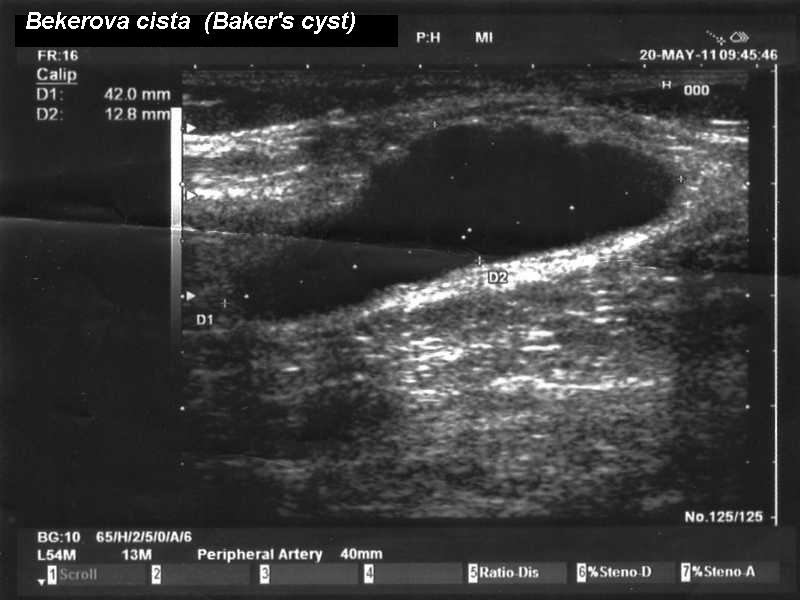 Ultrasound of popliteal fossa showing well-defined anechoic Baker cyst with characteristic neck communicating between gastrocnemius and semimembranosus