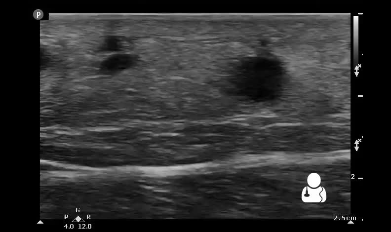 High-frequency linear ultrasound of superficial soft tissue showing subcutaneous edema and classic cobblestoning pattern in cellulitis