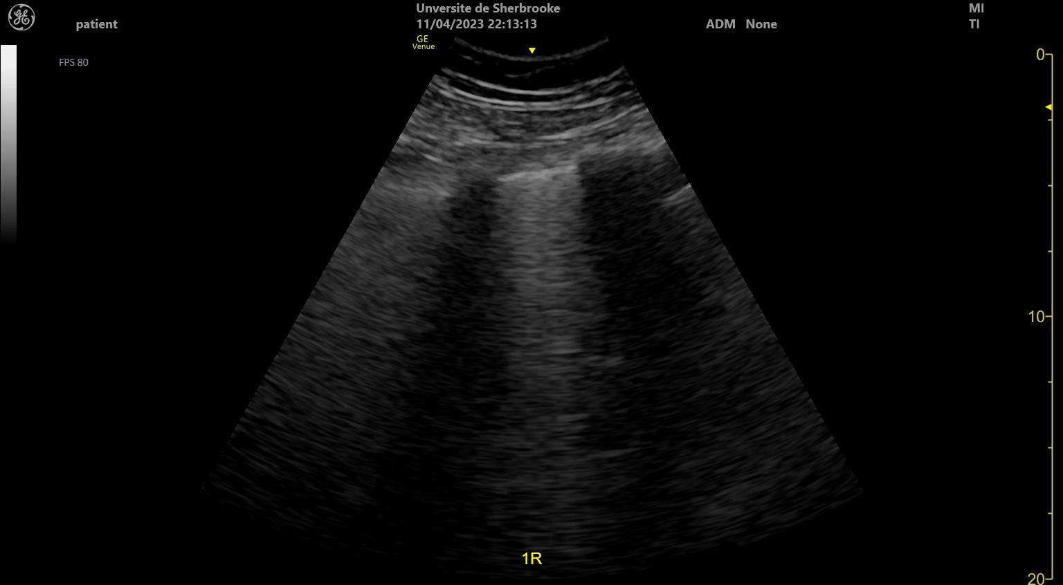 Thoracic lung ultrasound demonstrating multiple prominent vertical hyperechoic B-lines arising from the pleural line