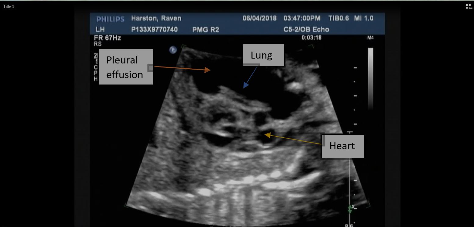 Thoracic ultrasound showing large anechoic pleural effusion above the diaphragm with floating atelectatic lung