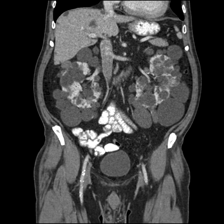 ADPKD Abdominal CT