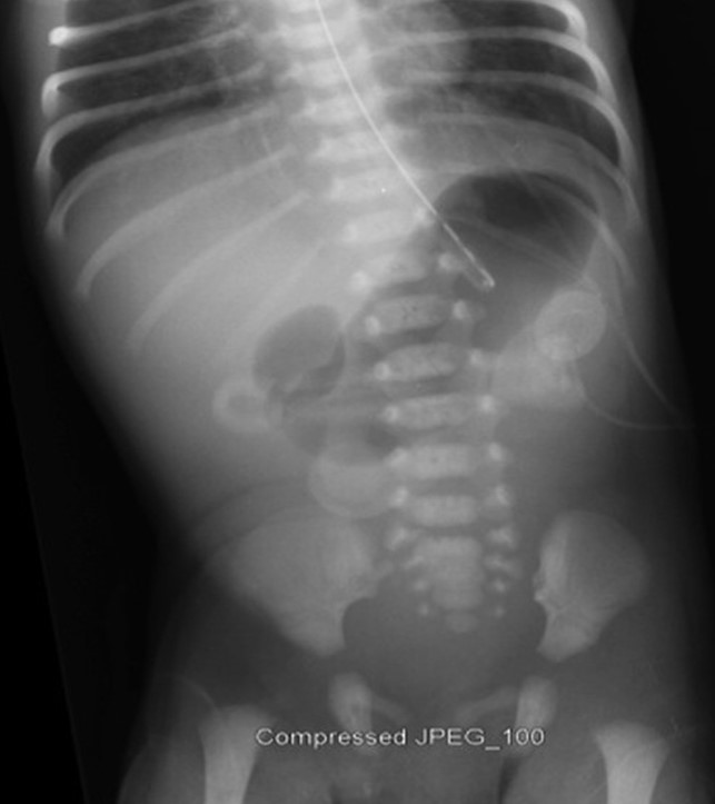Duodenal Atresia Double Bubble Sign