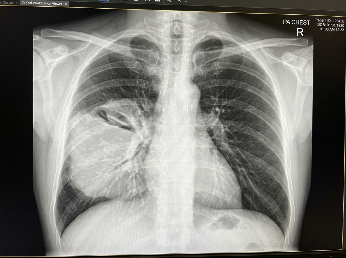 Right Lower Lobe Consolidation Lobar Pneumonia CXR