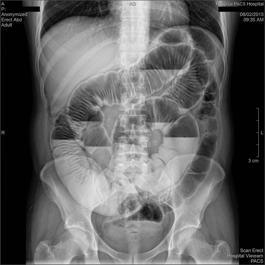 Small Bowel Obstruction on Abdominal Radiograph
